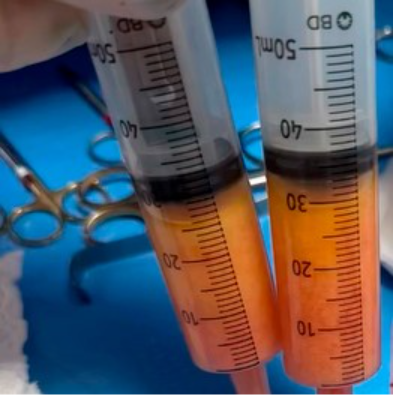 Faloplastia com Células Tronco